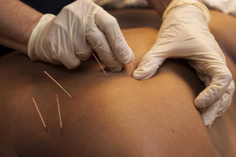 dry-needling-first-para-pic-new